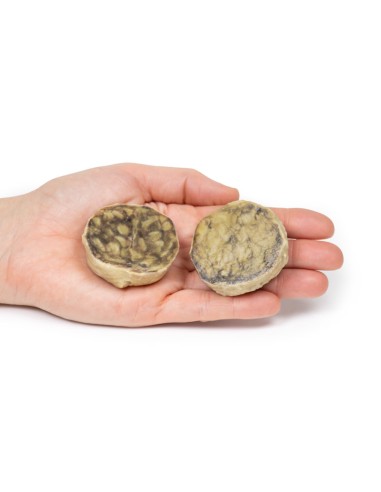 Iperplasia nodulare della prostata - Erler...