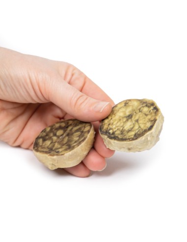 Iperplasia nodulare della prostata - Erler...