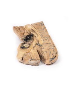 Berry-Aneurysma der Arteria basilaris - Erler Zimmer...