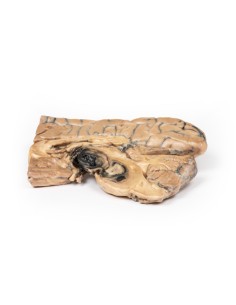 Berry-Aneurysma der Arteria basilaris - Erler Zimmer... 2