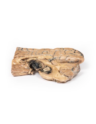 Aneurisma de Berry de la arteria basilar -...