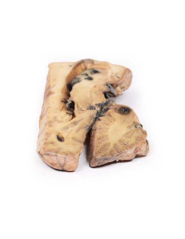 Aneurisma de Berry de la arteria basilar -...