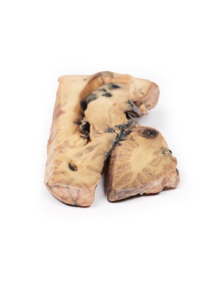 Berry-Aneurysma der Arteria basilaris - Erler Zimmer 3D-Anatomie Serie MP2001