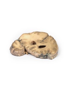 Metastatic adenocarcinoma in the brain - Erler Zimmer 3D... 2