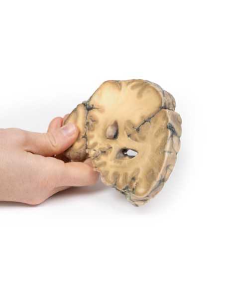 Adénocarcinome métastatique dans le cerveau - Erler Zimmer 3D anatomy Series MP2007