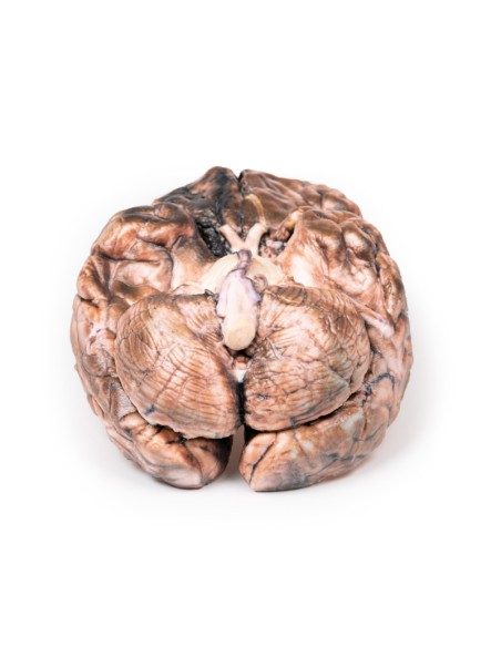 Aneurisma sacular - Erler Zimmer 3D anatomy Series MP2013