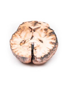 Säkuläres Aneurysma - Erler Zimmer 3D-Anatomie Serie MP2013 2