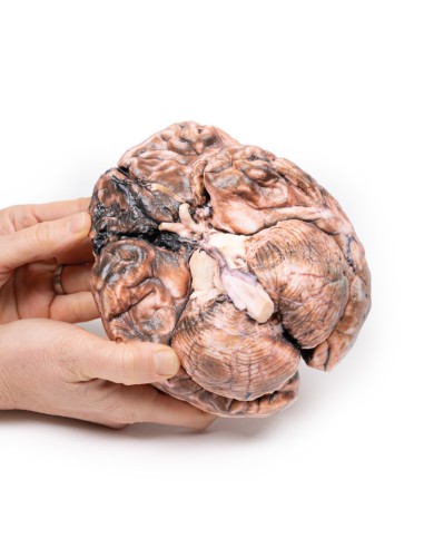 Aneurisma sacular - Erler Zimmer 3D anatomy...