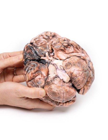 Aneurisma sacular - Erler Zimmer 3D anatomy Series MP2013