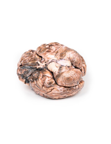 Aneurisma sacculare - Erler Zimmer 3D anatomy Series MP2013