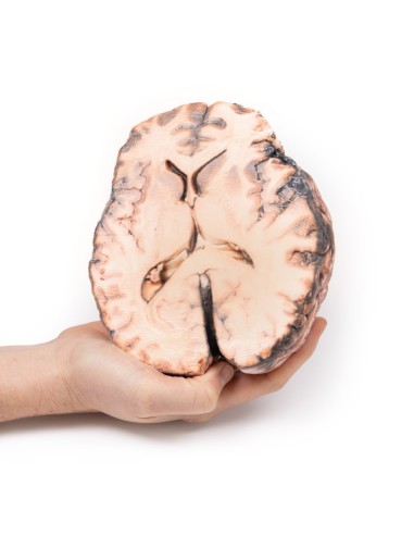 Aneurisma sacular - Erler Zimmer 3D anatomy...