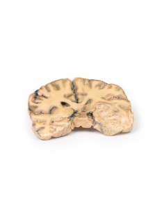 Astrocytoma - Erler Zimmer 3D anatomy Series MP2014