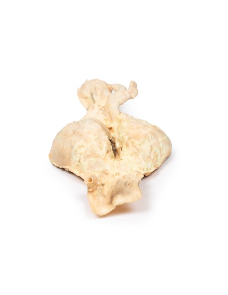 Aneurisma dell'aorta addominale - Erler Zimmer 3D anatomy Series MP2030