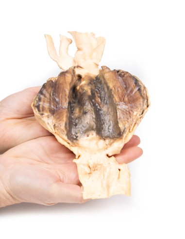 Aneurisma dell'aorta addominale - Erler Zimmer...