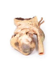 Syphilitisches Aneurysma - Erler Zimmer 3D Anatomie Serie...