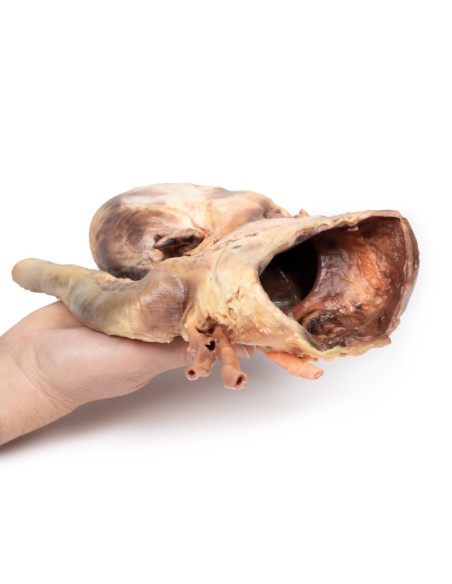 Syphilitisches Aneurysma - Erler Zimmer 3D Anatomie Serie MP2042