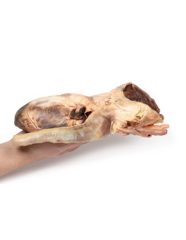 Syphilitisches Aneurysma - Erler Zimmer 3D...