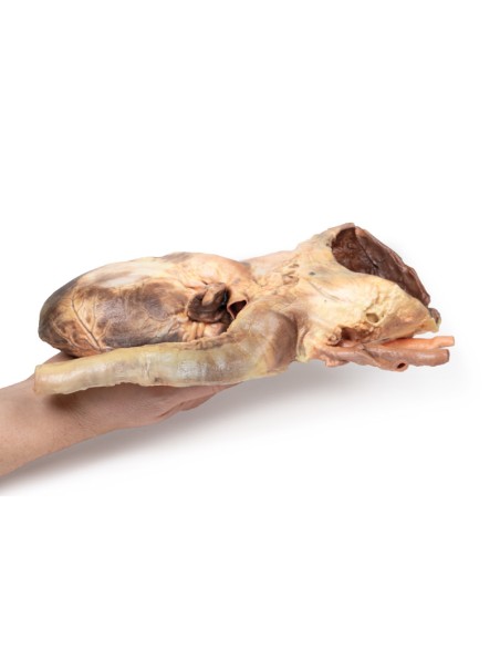 Anévrisme syphilitique - Erler Zimmer 3D anatomy Series MP2042