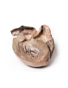 Anévrisme aortique thoracique rompu - Erler Zimmer 3D...