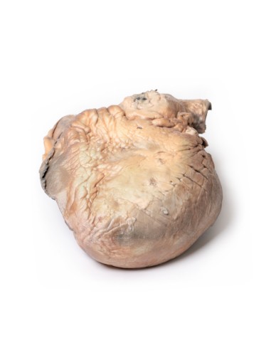 Aneurisma de aorta torácica roto - Erler Zimmer...