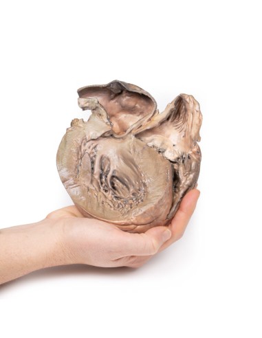 Aneurisma dell'aorta toracica rotto - Erler...