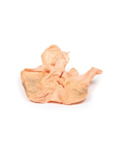 Adénocarcinome de l'estomac - Erler Zimmer 3D anatomy...