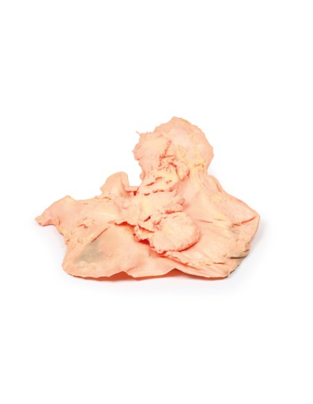 Adenocarcinoma de estómago - Erler Zimmer 3D anatomy Series MP2080