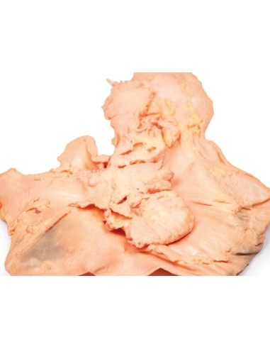 Adenocarcinoma de estómago - Erler Zimmer 3D...