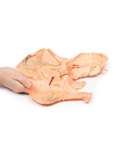 Adénocarcinome de l'estomac - Erler Zimmer 3D...