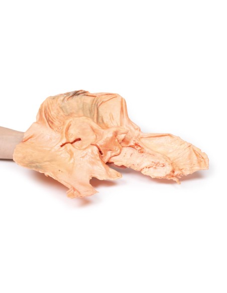 Adénocarcinome de l'estomac - Erler Zimmer 3D anatomy Series MP2080
