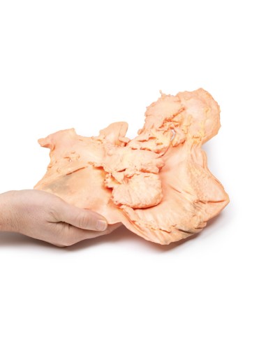 Adenocarcinoma de estómago - Erler Zimmer 3D...