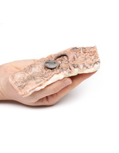 Adenoma pediculado de colon - Erler Zimmer 3D...