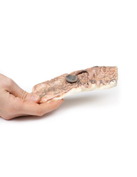 Gestieltes Adenom des Dickdarms - Erler Zimmer 3D anatomy Series MP2081