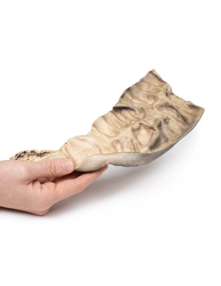 Maladie de Hirschsprung - Erler Zimmer 3D anatomy Series MP2079