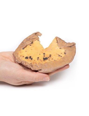 Metástasis mesentérica de melanoma maligno...