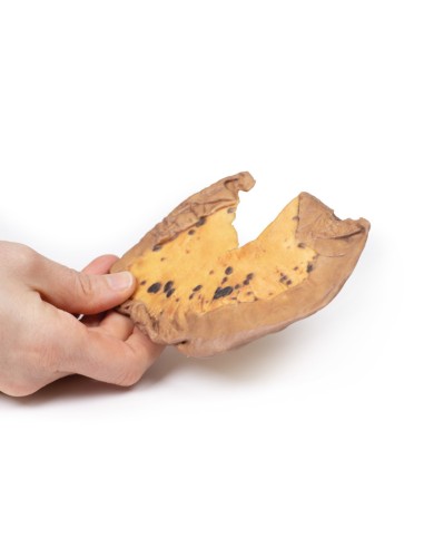 Metástasis mesentérica de melanoma maligno...