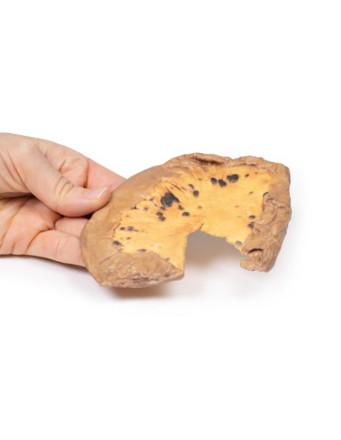 Metastasi mesenteriche da melanoma cutaneo...
