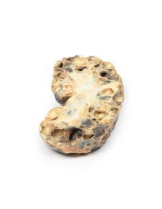 Polycystic kidney disease of the adult - Erler Zimmer 3D...