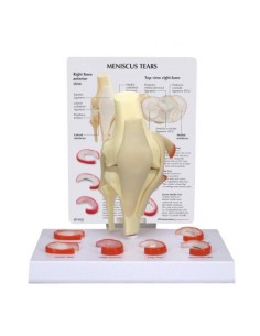 Anatomic model of meniscus with 6 lesions 3B Scientific...