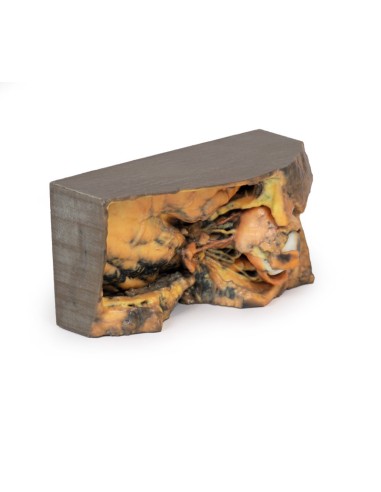 Seitlicher Orbit - Erler Zimmer 3D Anatomie...