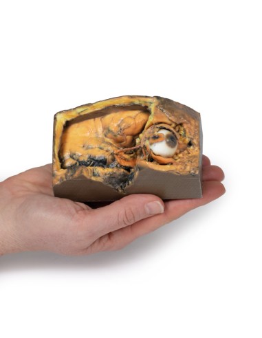 Seitlicher Orbit - Erler Zimmer 3D Anatomie...