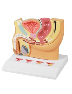 Section of the male pelvis with prostate disease Erler...