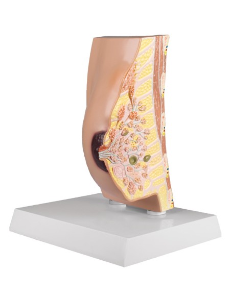 Erler Zimmer, modello anatomico di seno femminile con patologie L280