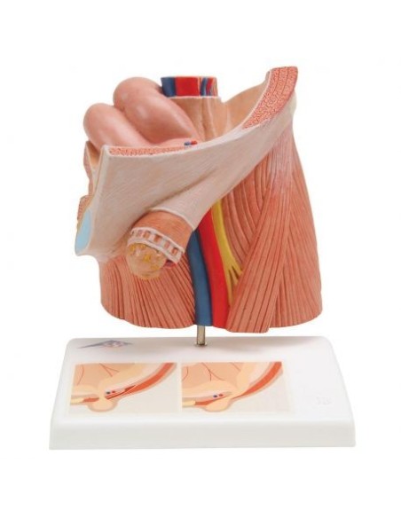 Anatomical model of inguinal hernia, 3B Scientific H13