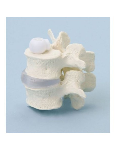 Erler Zimmer, modellino anatomico di due vertebre lombari a montaggio elastico 4090