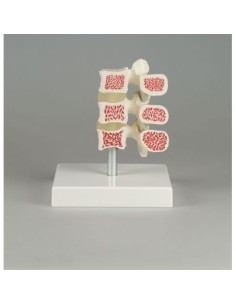 Erler ZImmer, modèle anatomique de l'ostéoporose,...