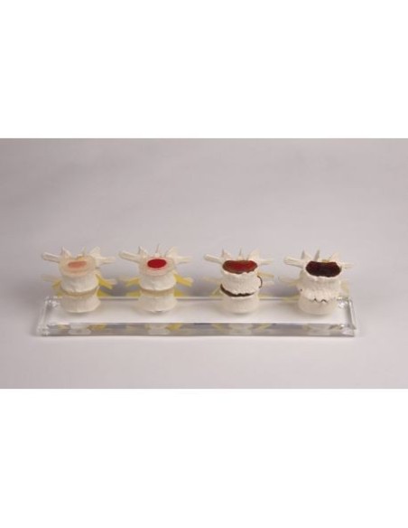 Erler Zimmer, Anatomical model of stages of intervertebral disc degeneration, in 4 parts 7577