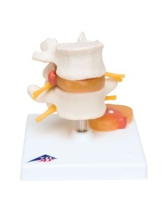 Model of lumbar vertebrae with herniated disc 3B...