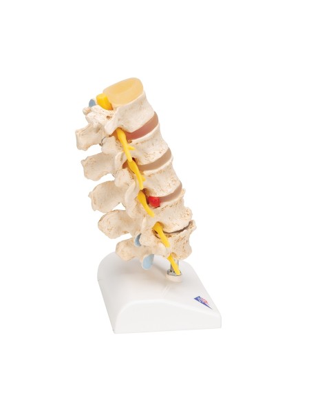 3B Scientific, Etapas de la hernia discal intervertebral y degeneración vertebral A795