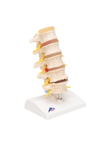 3B Scientific, Etapas de la hernia discal...